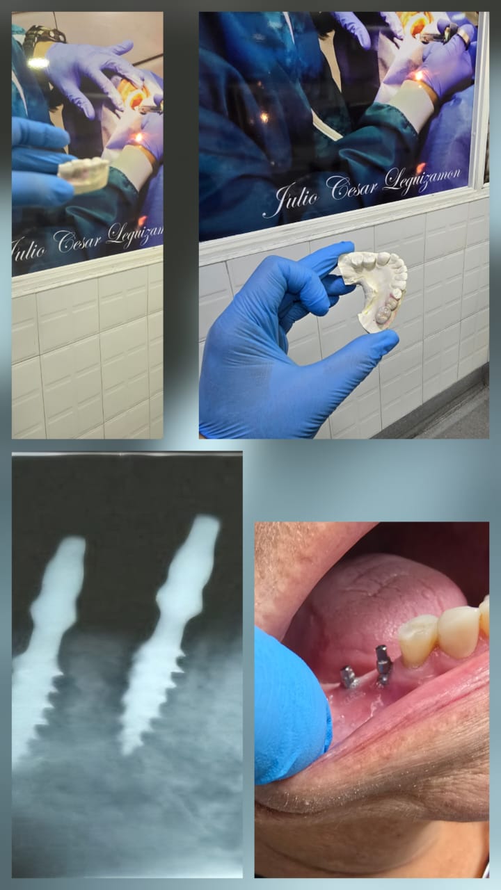 Cirugía de Implantes Avanzada