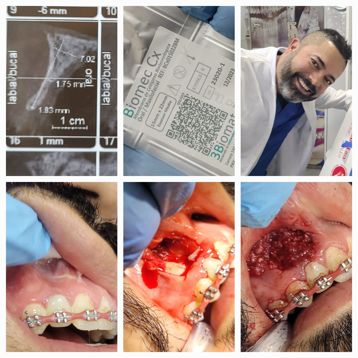 Rehabilitación con Implantes Múltiples